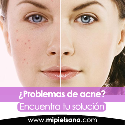 Piel sin Acne